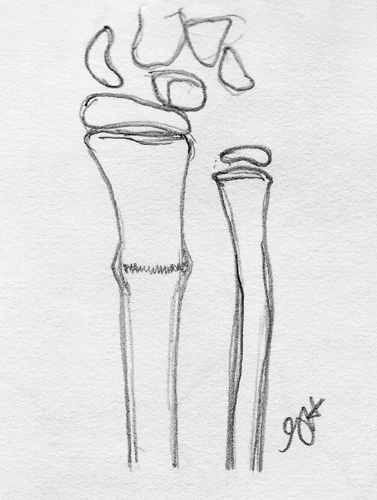<p>What is the typical cause of a buckle fracture?</p>