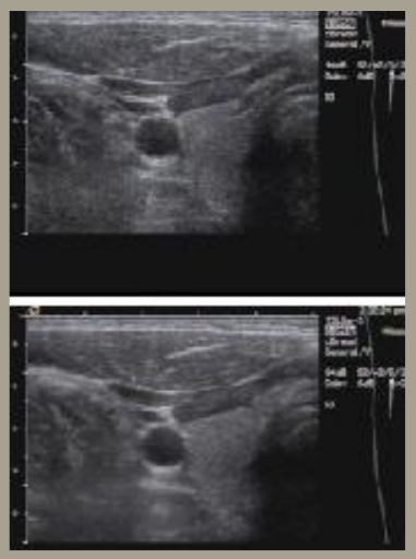 <p>describe the persistence of the following thyroid images</p>