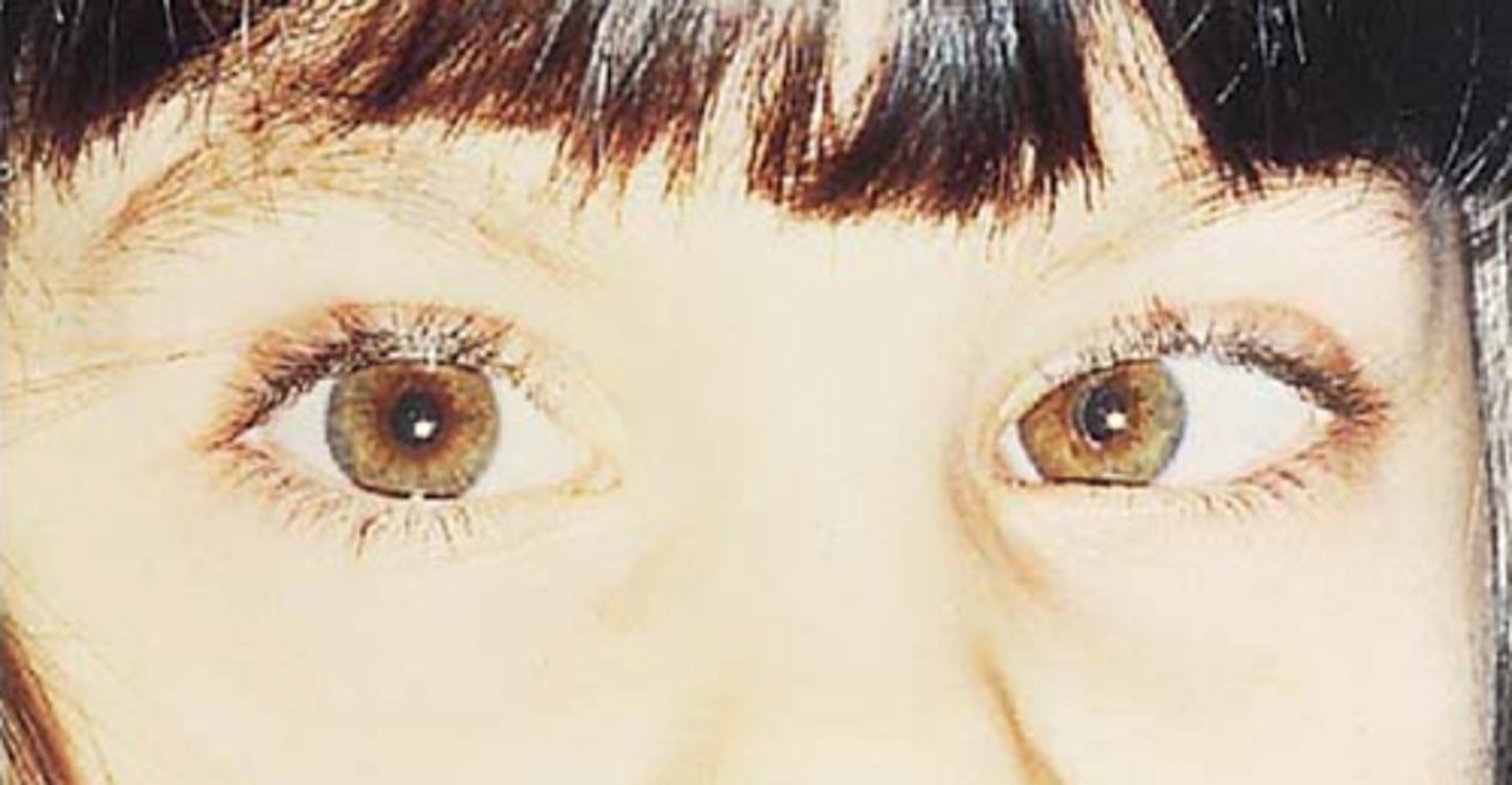 <p>misalignment of the eyes due to one set of extrinsic muscles being stronger than the other</p>