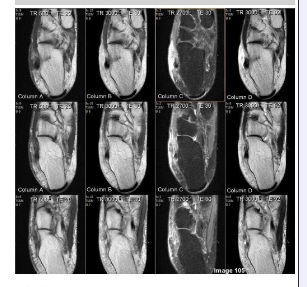 <p><span>&nbsp;Column A in Image 105 corresponds to which MRI pulse sequence?</span></p><p><span>&nbsp;A. Proton density</span></p><p><span>&nbsp;B. T1 weighted</span></p><p><span>&nbsp;C. T2 weighted</span></p><p><span>&nbsp;D. Proton density with fat suppression</span></p><p><span>&nbsp;E. T2 weighted with fat suppression</span></p>