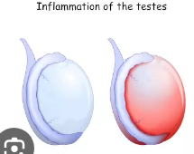 <p>= tender swelling of testis (acute inflammation)</p><ul><li><p>enlarged, edematous, reddened</p></li><li><p>does not transilluminate</p></li></ul>