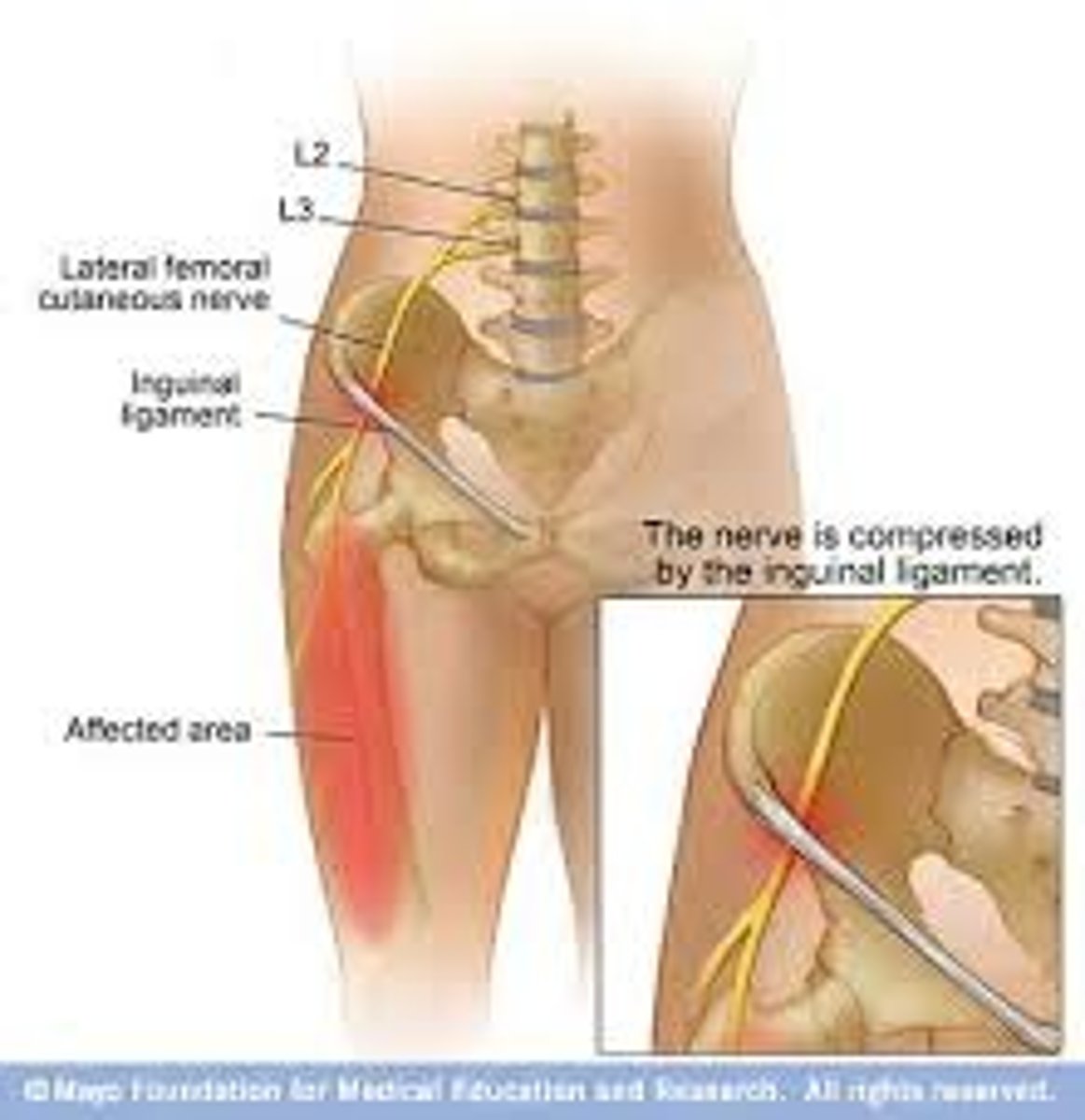 <p>- lateral femoral cutaneous nerve becomes compressed can be caused from tight clothing, obesity, pregnancy, hip-hugging belts</p><p>- numbness/tingling presents in the lateral thigh</p>