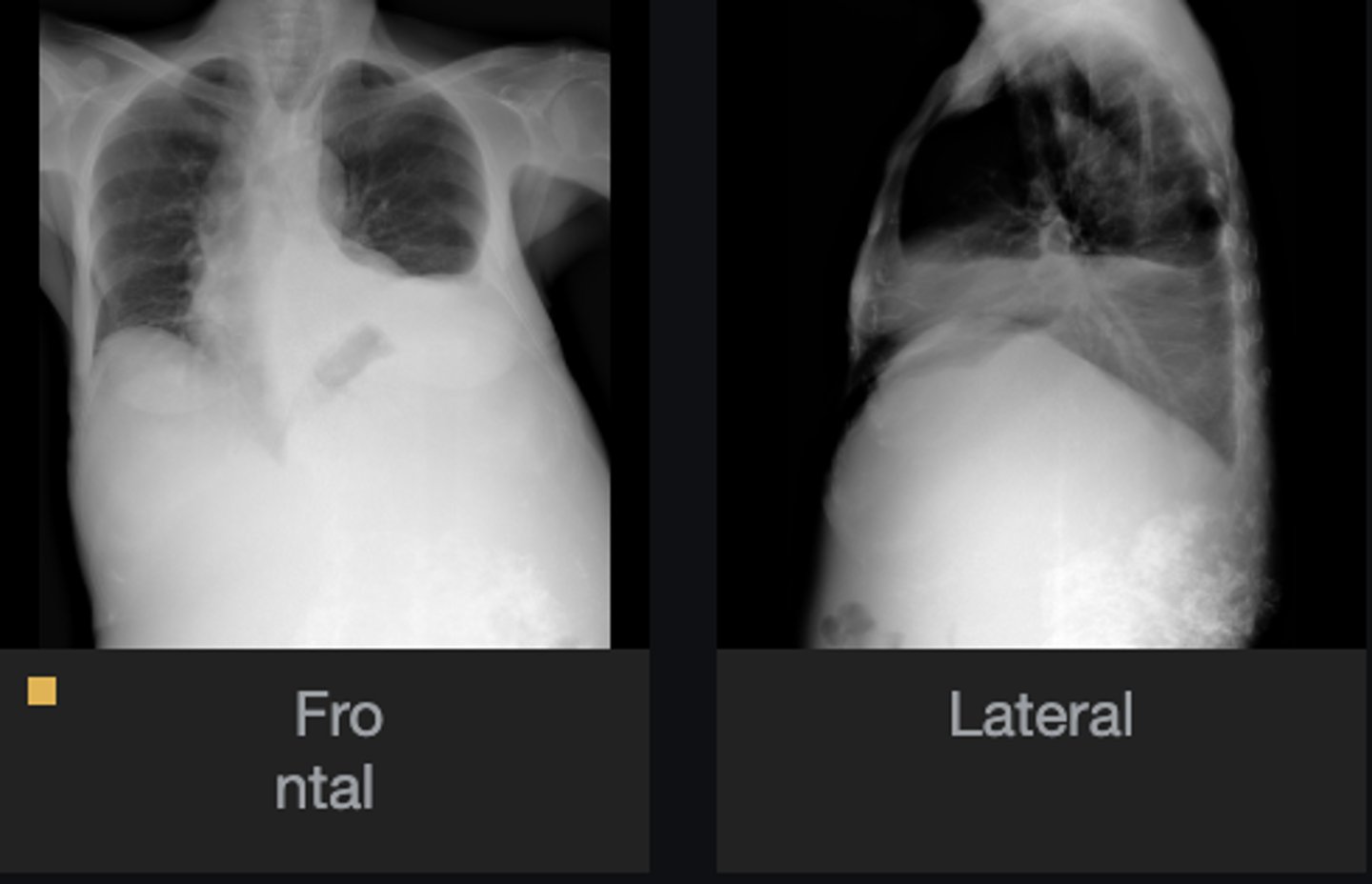 <p>Most likely diagnosis?</p>