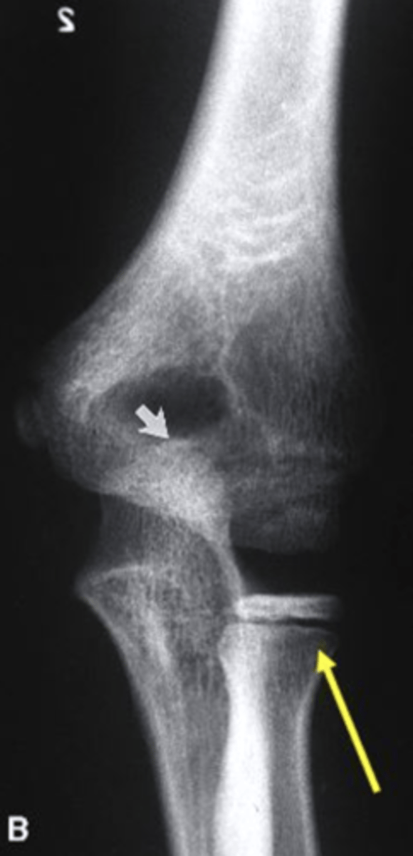 <p>growth plate of the radius</p><p>3 multiple choice options</p>
