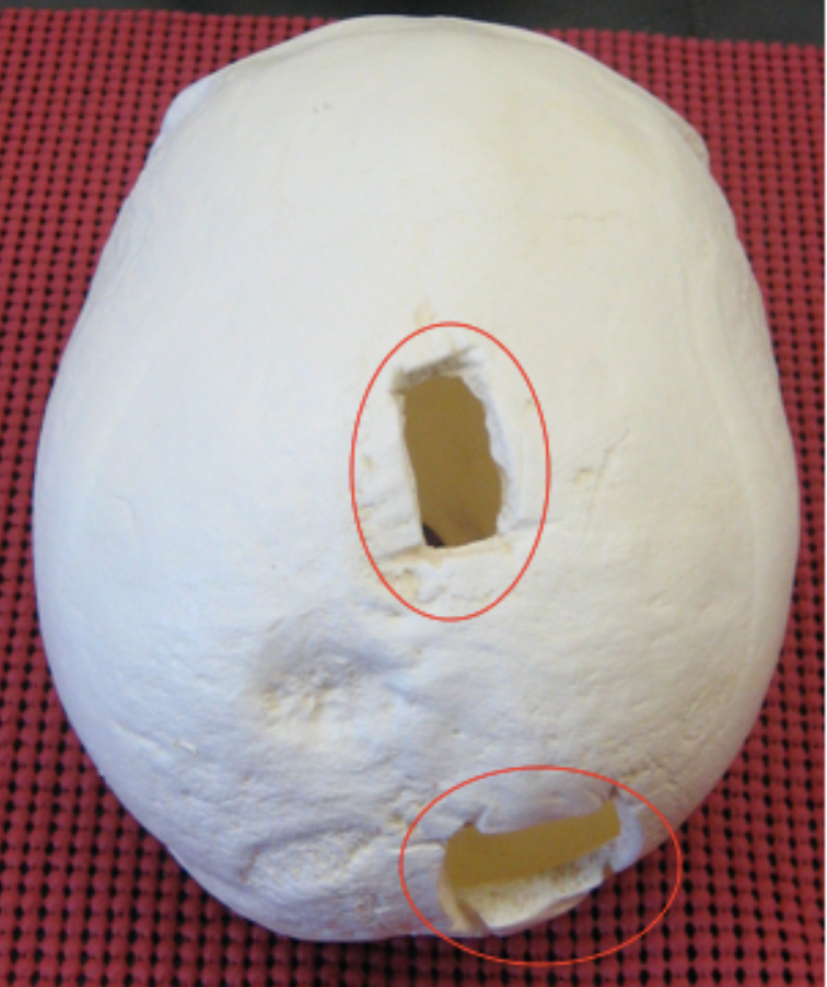 <p><span>Is this injury antemortem, perimortem, or postmortem?</span></p>