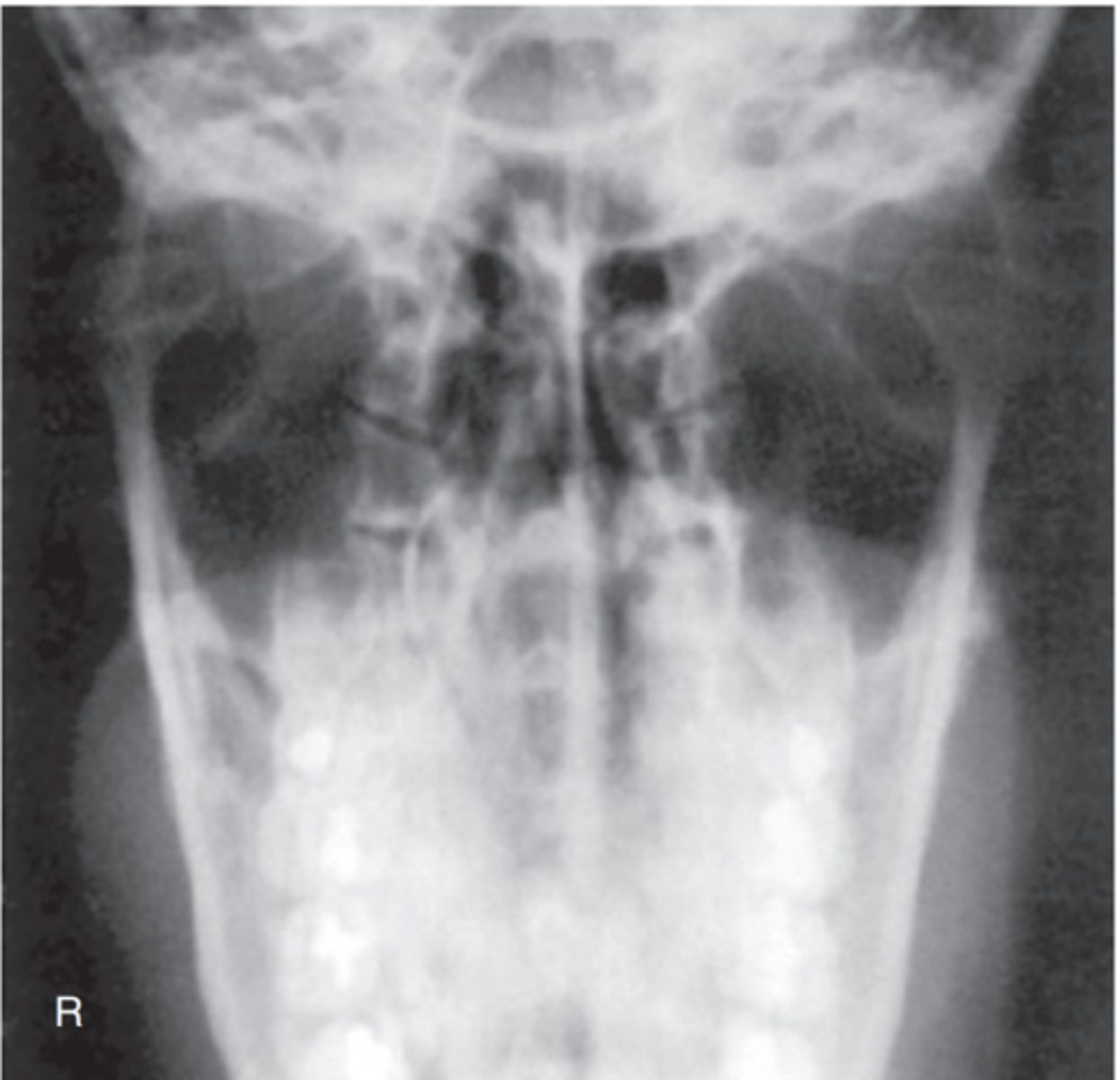 <p>-Position: Correctly positioned patient, with no rotation, is indicated by the following: condyloid processes visualized symmetrically, lateral to the cervical spine; clear visualization of condyle and TM fossae relationship.</p>