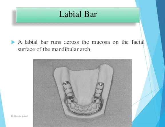 <ul><li><p>mandibular major connector </p></li><li><p>form + usage same as lingual bar but placed bucally due to sever lingual inclination of remaining teeth </p></li></ul><p></p>