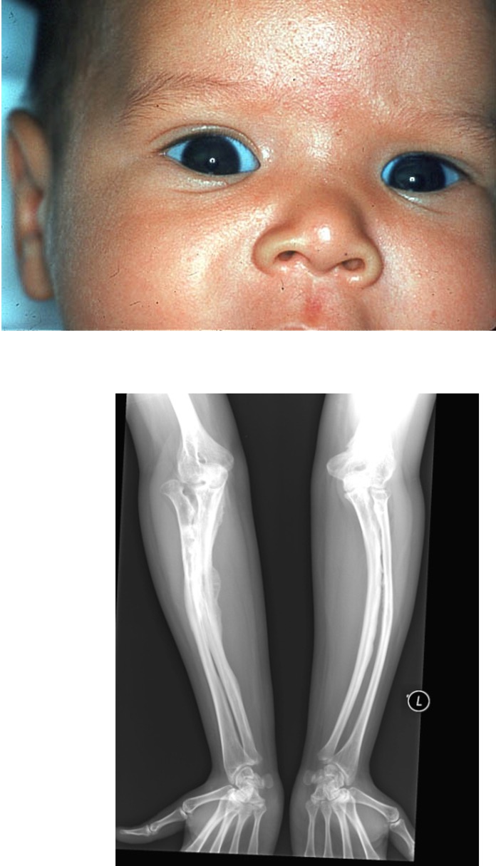 <ul><li><p><span><span>frequent fractures</span></span></p></li><li><p><span><span>blue sclera</span></span></p></li><li><p><span><span> thin, soft skin</span></span></p></li><li><p><span><span>short stature</span></span></p></li><li><p><span><span>hearing loss</span></span></p></li><li><p><span><span>delay in walking</span></span></p></li></ul><p></p>