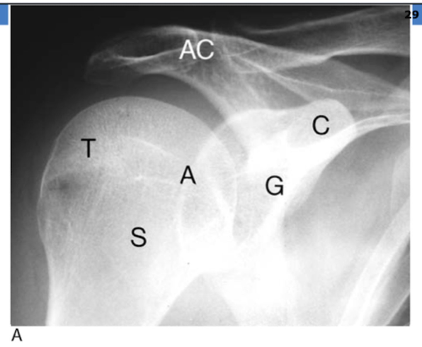 <p>T → greater tuberosity</p><p>S → surgical neck of humerus</p><p>A → anatomical neck of humerus</p><p>G → glenoid fossa</p><p>C → coracoid process</p><p>AC → acromion process</p>