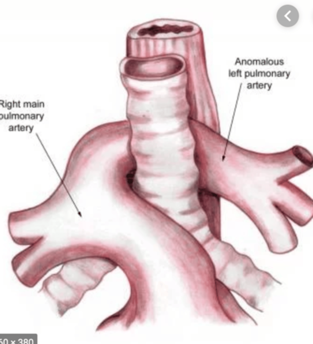 <p>Upwards of 80% of infants with a left PA sling will have associated anatomic tracheal stenosis characterized by complete circular cartilaginous rings (absence of the membranous trachea).</p>