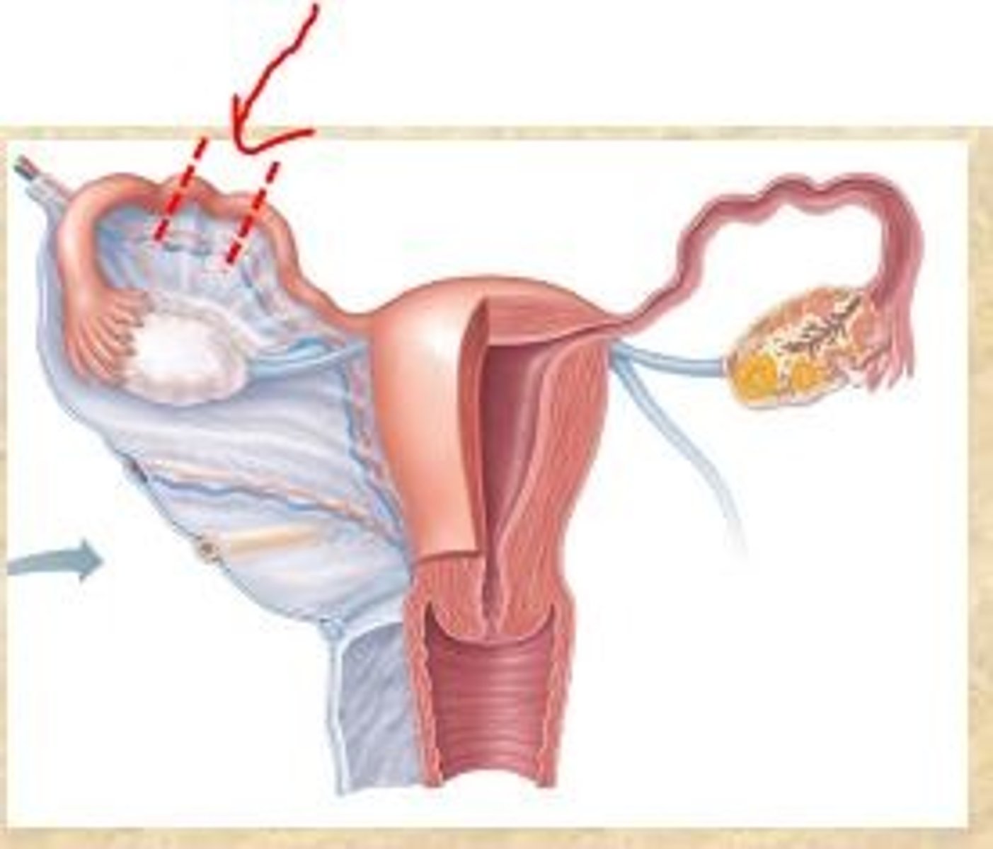 <p>removal of fallopian tube</p>