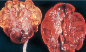 <p>Coagulative necrosis</p>