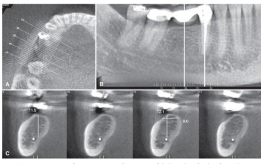 <p>What does CBCT allow in implant planning?</p>