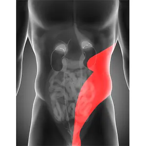 <p><strong>Which of the following pain descriptions would lead the nurse to suspect the client is experiencing ureteral colic?</strong></p><p>A) Right upper quadrant pain that worsens with deep breaths and palpation</p><p>B) Excruciating pain in the flank and upper outer quadrant of the abdomen that radiates to the bladder area</p><p>C) Pain described as “fire poking in their side,” pulsating with every heart beat but decreases when in fetal position</p><p>D) Perineal pain that increases when urinating and then lessens until the time to urinate again</p>