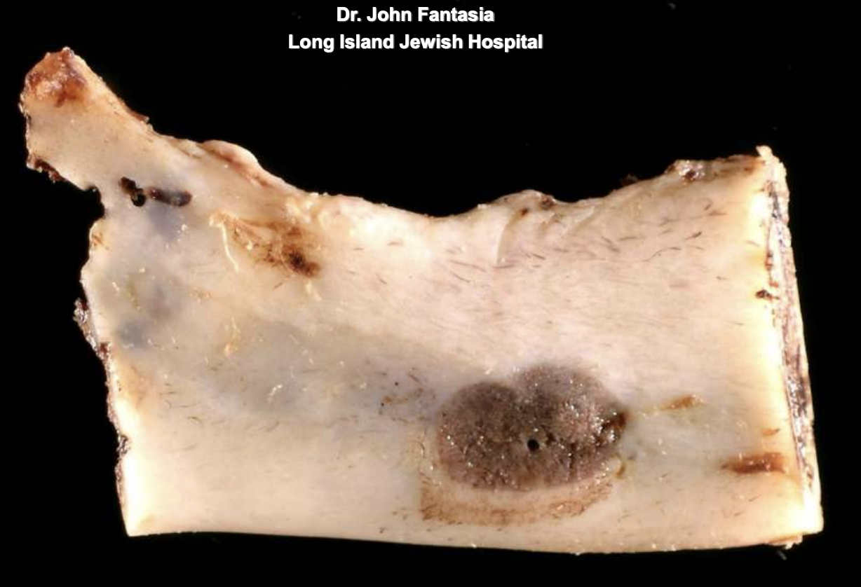 <p>ameloblastoma</p>