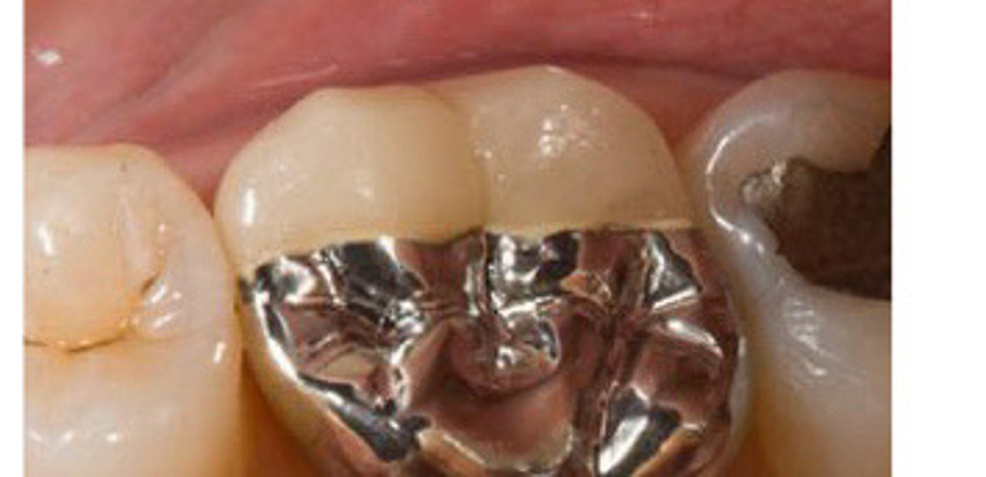 <p>PFM __ occlusal</p>