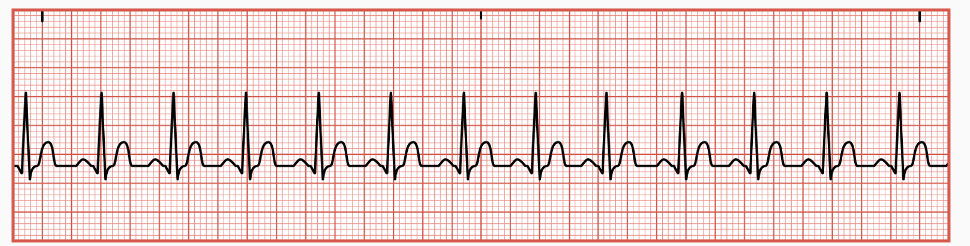 <p>Occurs when SA node sends a faster electrical impulse greater than 100 bpm</p>