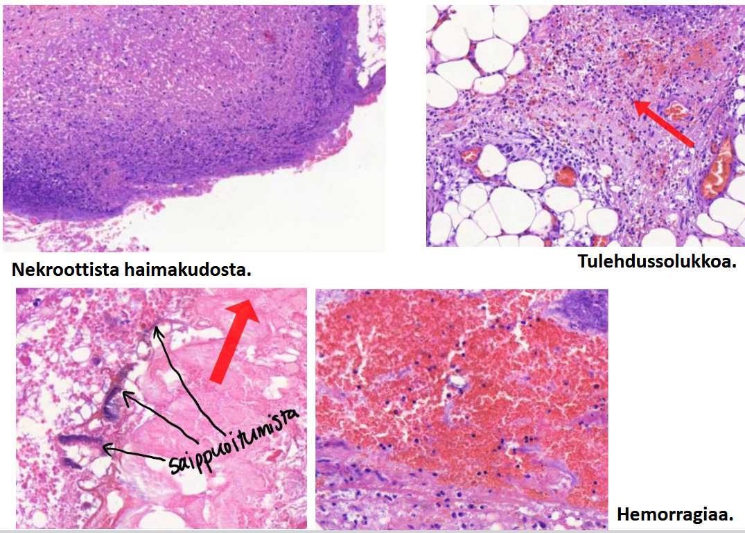 <p>päättele kuvista, mikä tauti on kyseessä?</p>