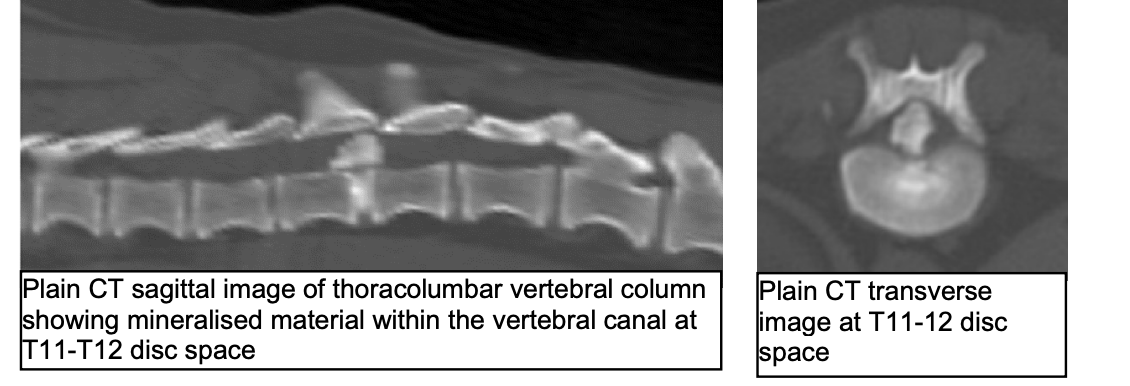 <p>3D image free from superimposition o Wider availability, less costly and much faster – vs. MRI o Characteristics compatible with acute intervertebral disc extrusion in CT: hyperattenuating (white) material within the vertebral canal, loss of epidural fat and distortion of the spinal cord o Soft tissue structures have similar appearance – spinal cord, cerebrospinal fluid and meninges o 82-100% sensitivity in the thoracolumbar region</p>