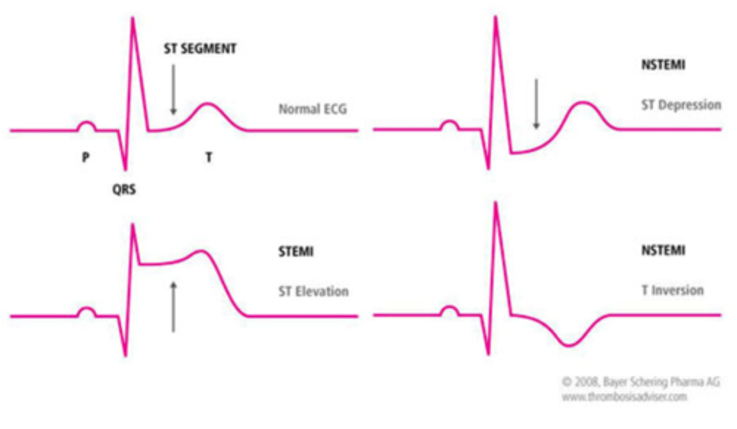 <p>affected area can be identified on a 12-lead ECG (ST-segment depression (NSTEMI) or ST-segment elevation (STEMI))</p>