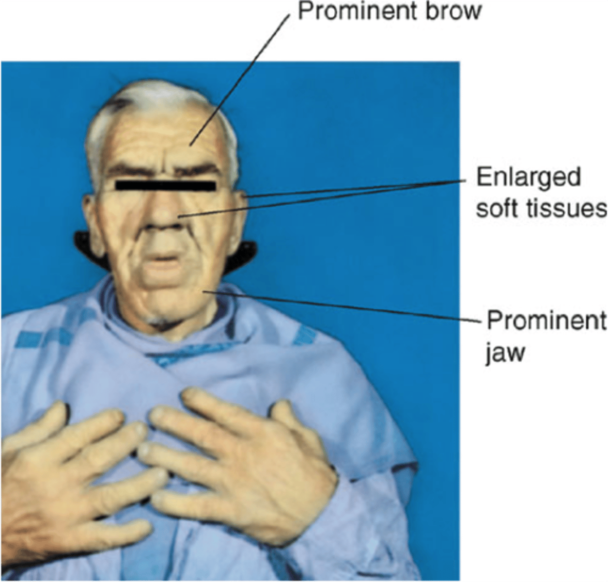 <p>1. Change in appearance<br>2. Increase in size of hands and feet<br>3. Excessive sweating<br>4. Headache<br>5. Tiredness<br>6. Weight gain<br>7. Amenorrhoea<br>8. Deep voice<br>9. Goitre</p>