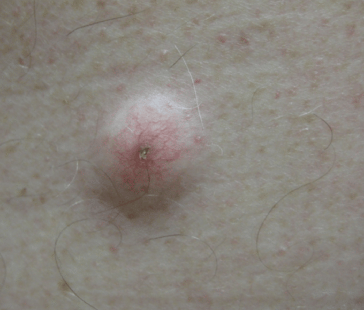 <p>What do epidermal inclusion cysts arise from?</p>