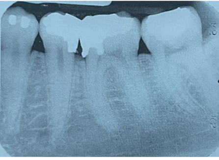 <p><span>This radiograph is mounted labially. What is the radiopaque restoration on tooth #19 in this image?</span></p><ul><li><p><span>composite restoration with an overhang on the mesial surface</span></p></li><li><p><span>amalgam restoration with an overhang on the mesial surface</span></p></li><li><p><span>composite restoration with an overhang on the distal surface</span></p></li><li><p><span>amalgam restoration with an overhang on the distal surface</span></p></li></ul><p></p>