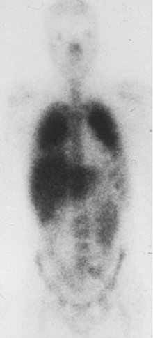 <p>Radioactive gallium citrate</p>