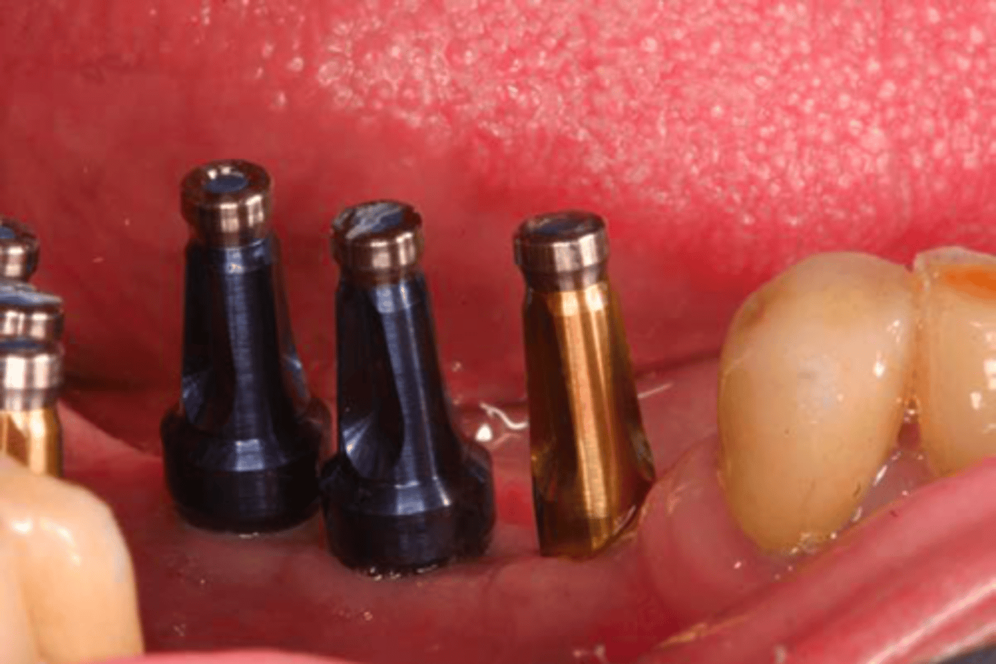 <p>ID the technique: remove healing abutment and place appropriate impression copings </p><p>(yellow = regular, blue = wide)</p>
