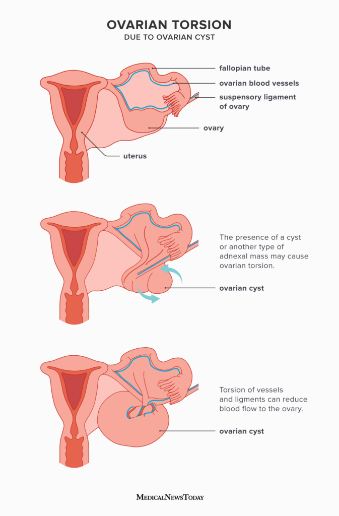 <p>Ovarian torsion </p>