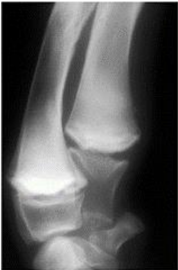 <p><strong>Hypertrophic Osteodystrophy (HOD) is?</strong></p>