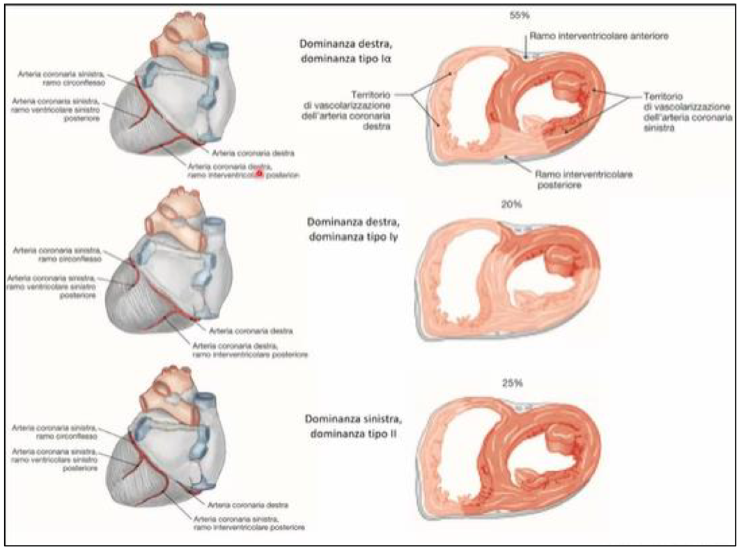 <p>Il termine dipende dall’origine dell’arteria interventricolare posteriore:</p><ul><li><p>Dominanza destra (più frequente) → quando origina dalla coronaria destra</p></li><li><p>Dominanza sinistra → quando origina dalla coronaria sinistra</p><ul><li><p>in questo caso sia la interventricolare posteriore che anteriore originano dalla coronaria sx, che quindi vascolarizza tutto il setto interventricolare</p></li></ul></li><li><p>Codominanza → quando entrambe contribuiscono alla vascolarizzazione posteriore del setto</p></li></ul><p>Sottotipi di Dominanza Destra:</p><ul><li><p>Tipo 1 alfa (più frequente):</p><ul><li><p>Con rami settali posteriori dall’arteria interventricolare posteriore per i 1/3 posteriore del setto</p></li><li><p>E rami settali anteriori dall’arteria interventricolare anteriore per i 2/3 anteriori del setto</p></li></ul></li><li><p>Tipo 1 gamma:</p><ul><li><p>I rami settali posteriori sono più estesi quindi irrorano i 2/3 posteriori, mentre quelli settali anteriori i 1/3 anteriori</p></li></ul></li></ul><p>Occlusioni più frequenti:</p><ul><li><p>L’estensione dell’infarto dipende dal tipo vaso occluso</p></li><li><p>Se l’occlusione coinvolge l’arteria interventricolare anteriore abbiamo un’infarto anteriore che coinvolge ventricolo sx e parte del dx</p></li><li><p>Se coinvolge l’arteria coronaria destra allora è coinvolto atrio e ventricolo dx</p></li></ul><p></p>
