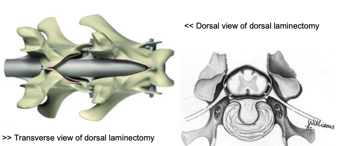 <p>Dorsal laminectomy +/- foraminotomy <span data-name="black_small_square" data-type="emoji">▪</span> +/- spinal distraction-stabilisation if instability</p>