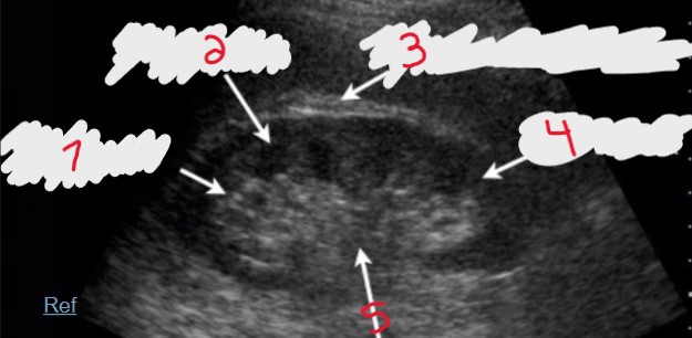 <p>Which number would be the correct structure for Gerota’s fascia? </p>