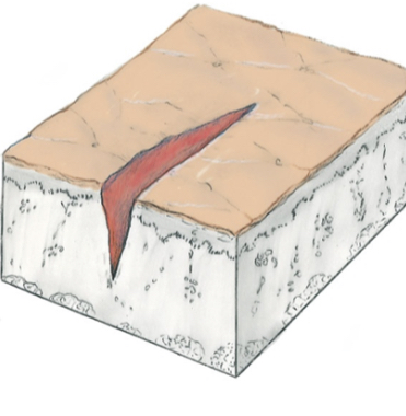Fissure