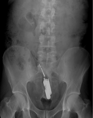 <p><span><span>•Abdomen:</span></span></p><p><span><span>–Stomach, bowels, liver, kidney, spleen, pancreas, diaphragm, urinary bladder, etc.</span></span></p><p><span><span>–Muscle, fat, and water very similar in composition</span></span></p><p><span><span>–Many shades of gray</span></span></p>