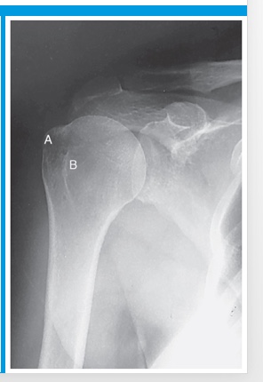 <p>position of humerus?</p>