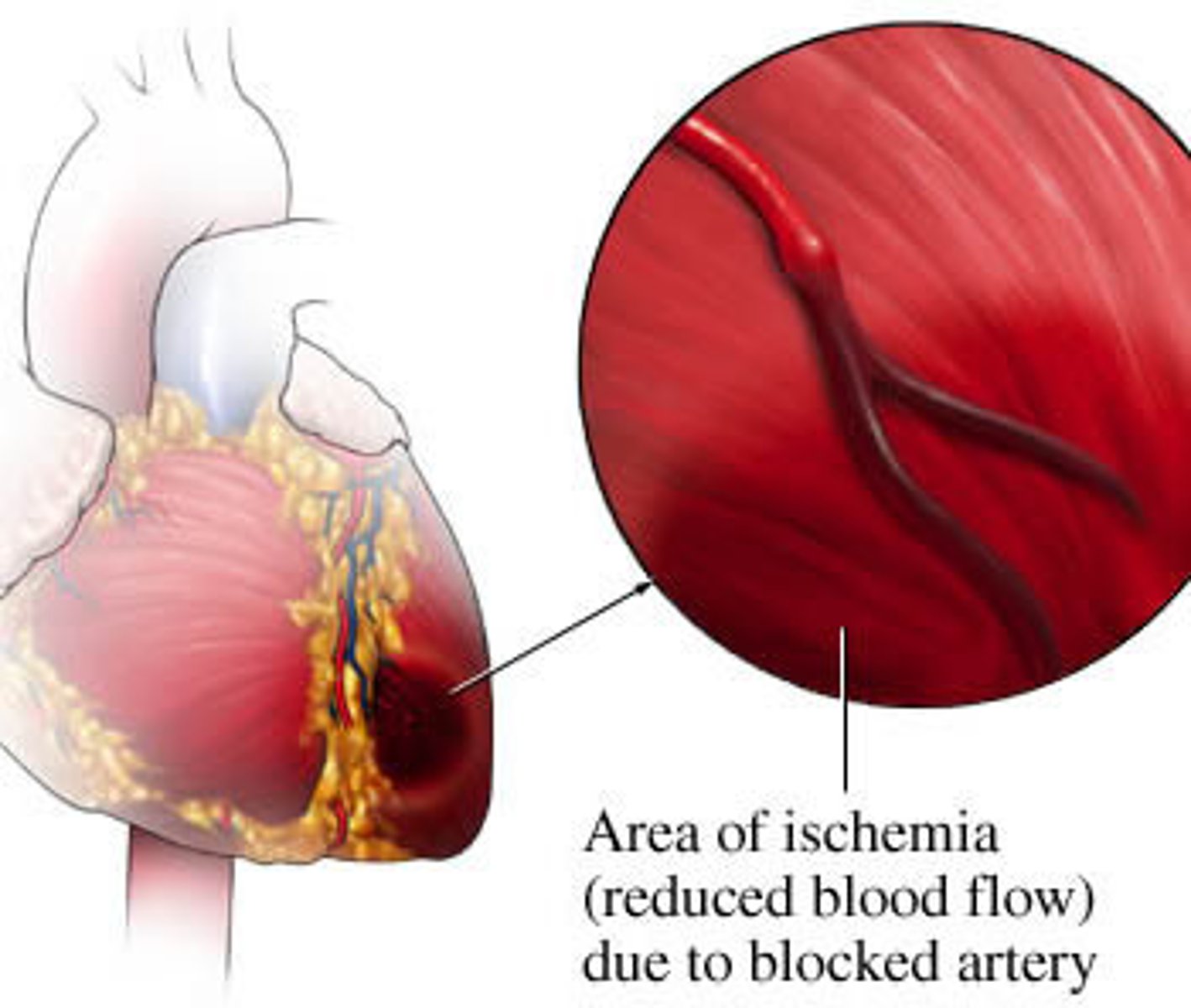 <p>A restriction in blood supply to tissues, causing a shortage of oxygen and glucose needed to keep tissue alive.</p>