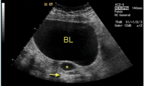<ul><li><p><u>Results from</u> either non-rupture of dominant mature follicle or failure of immature follicle to undergo normal process of atresia</p></li><li><p>May be multiple</p></li><li><p>Usually unilateral</p></li><li><p>Range <span style="color: rgb(255, 0, 0)">1-10 cm (usually 2 cm)</span></p></li><li><p>usually <span style="color: rgb(167, 0, 255)">asymptomatic</span> → regress spontaneously</p></li><li><p>Any simple cyst measuring <span style="color: rgb(255, 0, 0)">less than 5 cm</span> in an <u>ovulating woman</u> should be <strong>re-evaluated </strong>in<strong> 6-8 weeks</strong></p></li><li><p>Ruptured cysts will have free fluid in the <span style="color: rgb(0, 118, 255)">cul-de-sac</span> (likely <span style="color: rgb(0, 118, 255)">posterior cds</span>)</p></li></ul><p></p>