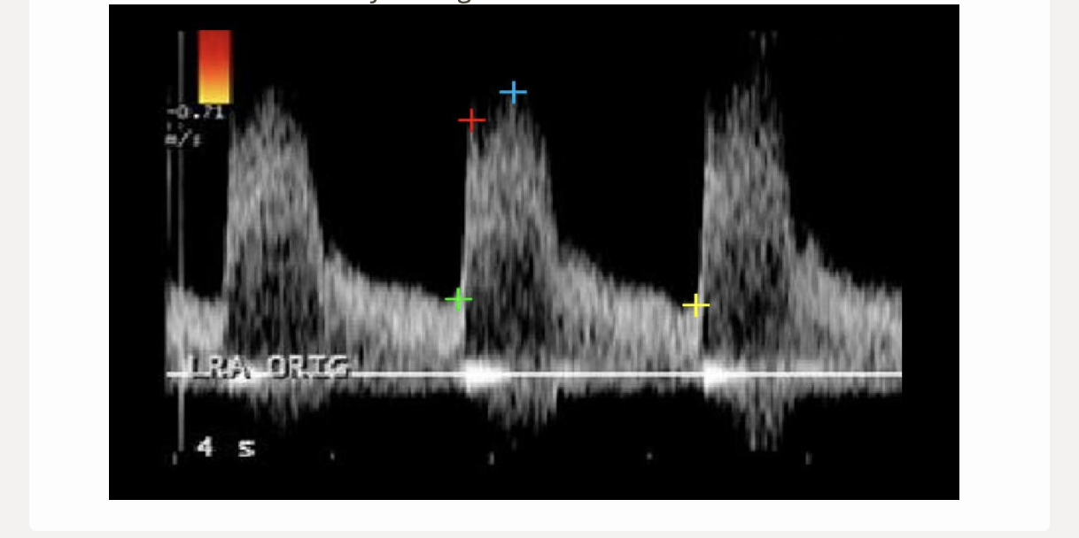 <p>which 2 cursors would be used to measure the acceleration time for this renal artery flow</p><p>.</p><p>a) green + yellow </p><p>b) green + red</p><p>c) red + blue</p><p>d) blue + green</p>