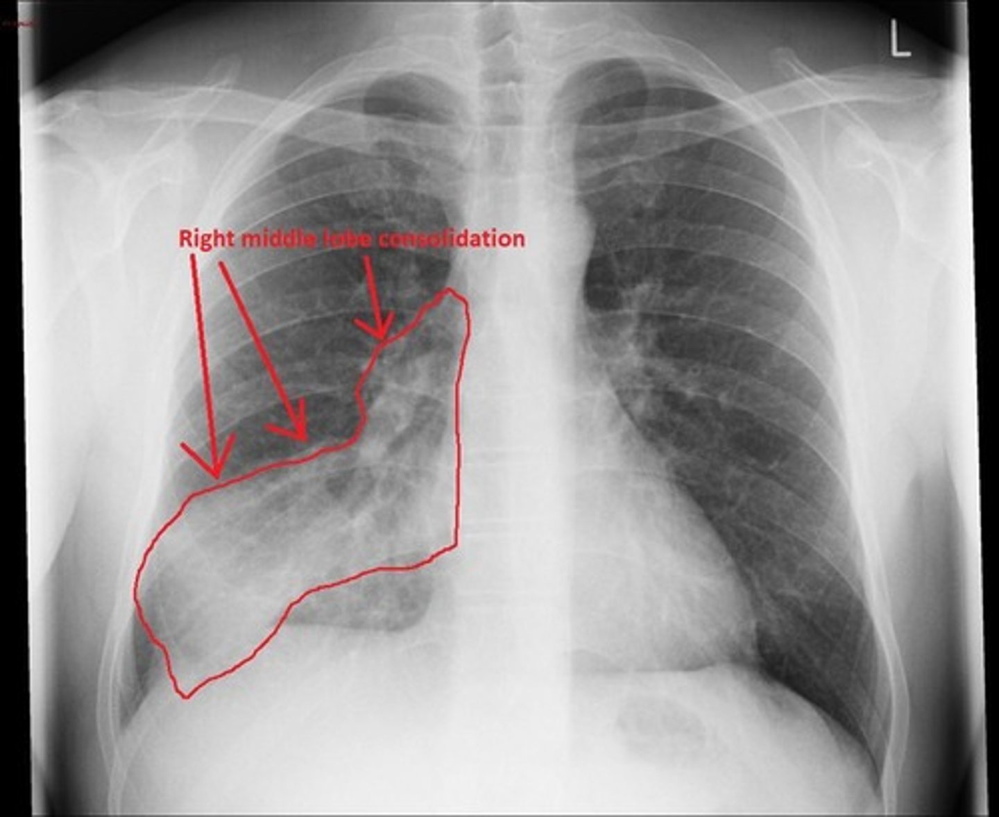 <p>Pleural effusion, pulmonary edema, consolidation, pneumothorax, and atelectasis.</p>