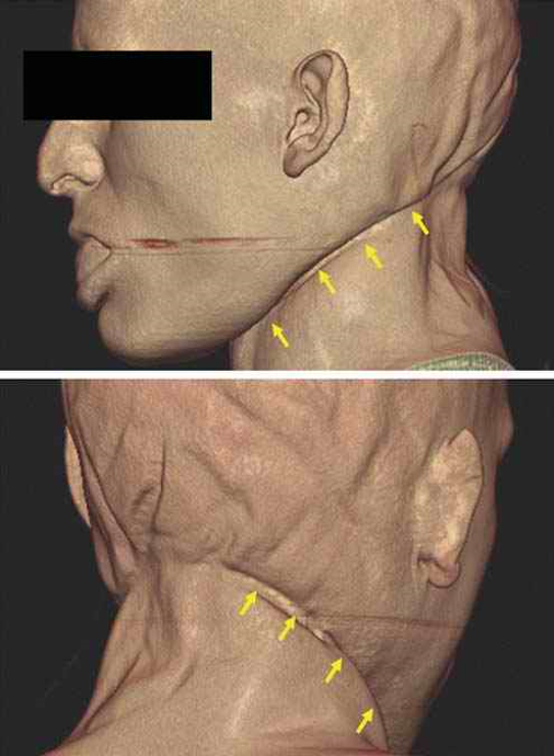 <p>Diagnosis? Describe neck injury</p>