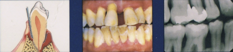 <ul><li><p><strong>Major loss of alveolar bone</strong> support </p></li><li><p>increased tooth mobility</p></li><li><p>Furcation involvement </p></li></ul><p></p>