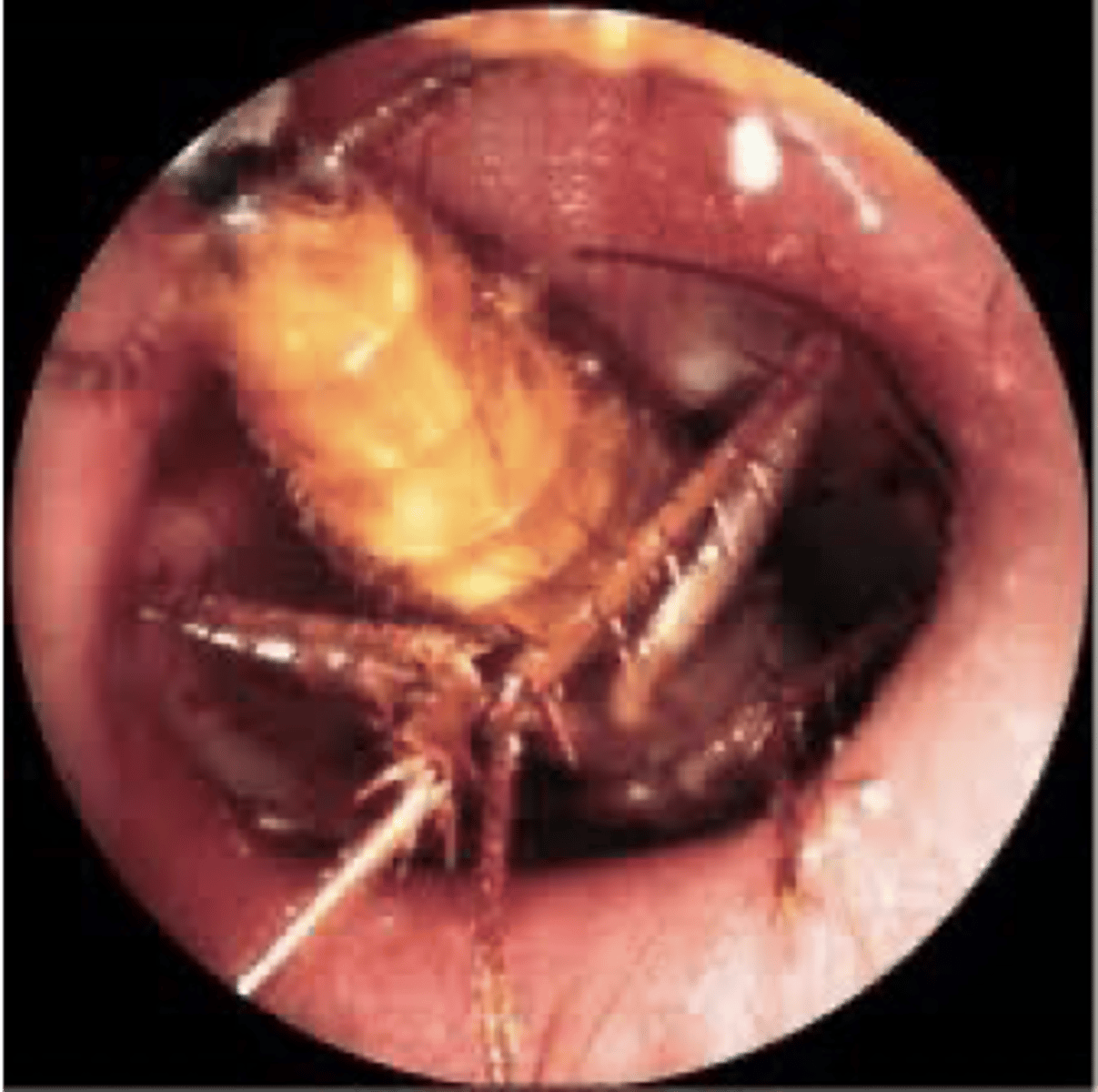 <p>can cause hearing loss if _______ occludes EAC, causes TM rupture, or substantial EAC swelling</p>