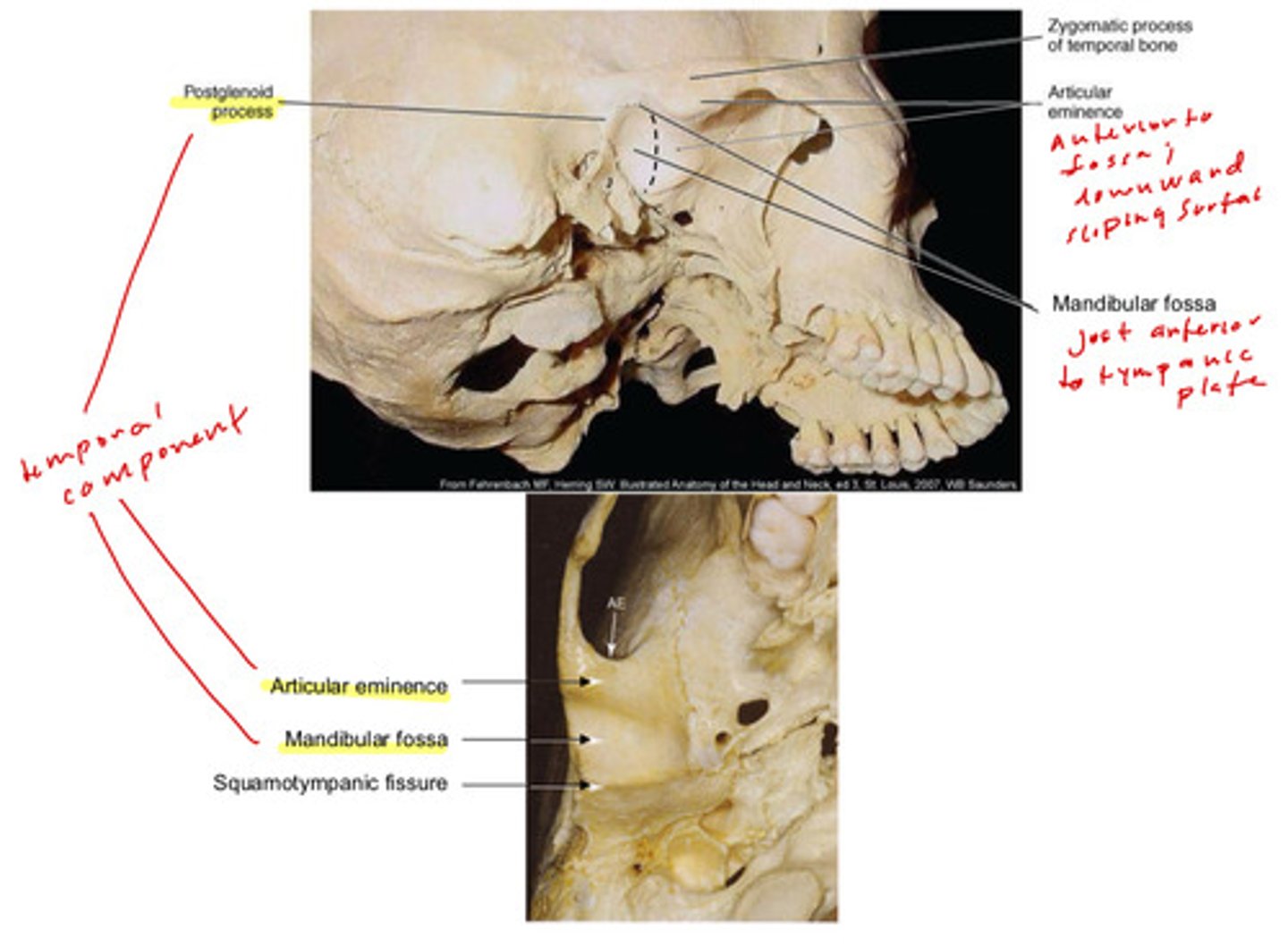 <p>1) postglenoid process</p><p>2) articular eminence</p><p>3) mandibular fossa</p><p>4) squamotympanic fissure</p><p>5) zygomatic process of temporal bone</p>