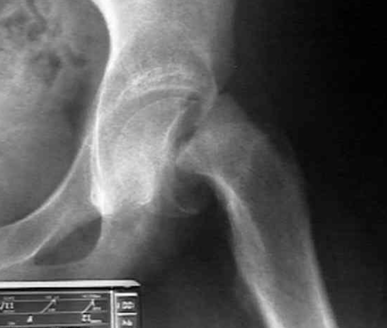 <p>Clinical manifestations for slipped capital femoral epiphysis:</p><ul><li><p>onset in who and when?</p></li><li><p>what side involvement in how many cases?</p></li><li><p>early presentation is what associated with what pain?</p><ul><li><p>referred to what side and of what 2 body parts?</p></li></ul></li><li><p>what is the motion limitation? (3)</p></li></ul>