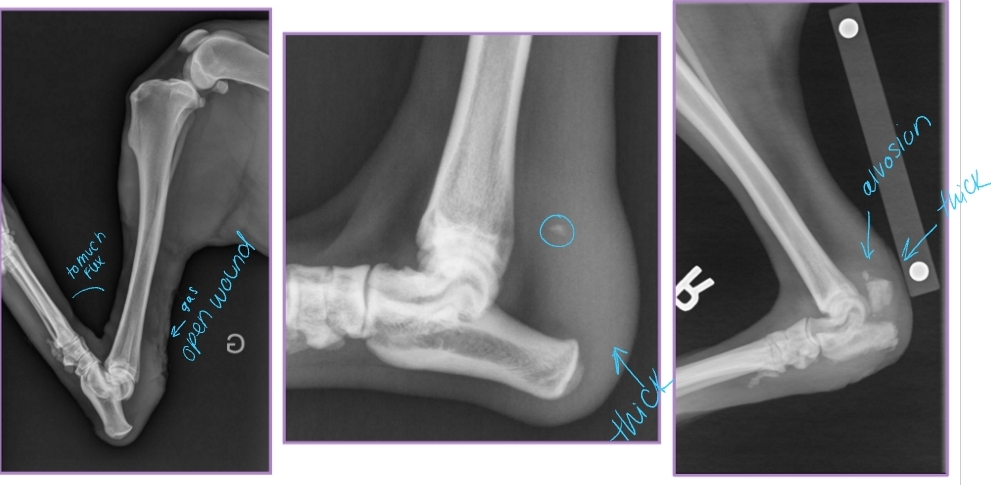 <ul><li><p><span style="background-color: transparent;"><strong><span>Et: </span></strong></span><span style="background-color: transparent; color: red;"><span>Mid-tendon laceration, Avulsion of tendon from calcaneus, Fracture of calcaneus</span></span></p><ul><li><p><span style="background-color: transparent;"><span>Cushing’s, Hypokalemia (cats), Diabetic neuropathy (cats)</span></span></p></li></ul></li><li><p><span style="background-color: transparent;"><strong><span>Sig:</span></strong><span> </span></span><span style="background-color: transparent; color: red;"><strong><span>Middle-aged to older, large breed dogs</span></strong></span></p></li><li><p><span style="background-color: transparent; color: red;"><strong><span>Cs: Flexed tarsus with extended stifle (“dropped hock”) & flexion of toes w/ WB (gripping floor, SDF intacted)</span></strong></span></p><ul><li><p><span style="background-color: transparent;"><span>Usually unilateral </span></span></p></li><li><p><span style="background-color: transparent;"><span>Mild = flexion of hock</span></span></p></li><li><p><span style="background-color: transparent;"><span>Severe = full collapse</span></span></p></li></ul></li></ul><ul><li><p><span style="background-color: transparent;"><strong><span>Dt: Chronic = thick tendon/minerals</span></strong></span></p><ul><li><p><span style="background-color: transparent;"><strong><span>Radiographs:</span></strong><span> Increased soft tissue opacity, Mineralization, Bone avulsion, Gas in soft tissue</span></span></p></li><li><p><span style="background-color: transparent;"><strong><span>US: </span></strong><span>Focal hypoechoic area in tendon</span></span></p></li></ul></li></ul><ul><li><p><span style="background-color: transparent;"><strong><span>Tx: </span></strong></span><span style="background-color: transparent; color: red;"><strong><span>Surgical repair + EC (#1), (sx not option) EC w/ Hock in moderate extension 8w post-op</span></strong></span></p><ul><li><p><span style="background-color: transparent;"><span>Repair tendon or avulsed calcaneus, tension band fixation</span></span></p></li><li><p><span style="background-color: transparent;"><span>External coaptation alone is not effective</span></span></p></li></ul></li></ul><ul><li><p><span style="background-color: transparent;"><strong><span>Px:</span></strong><span> Long, frustrating recovery process</span></span></p></li></ul><p></p>