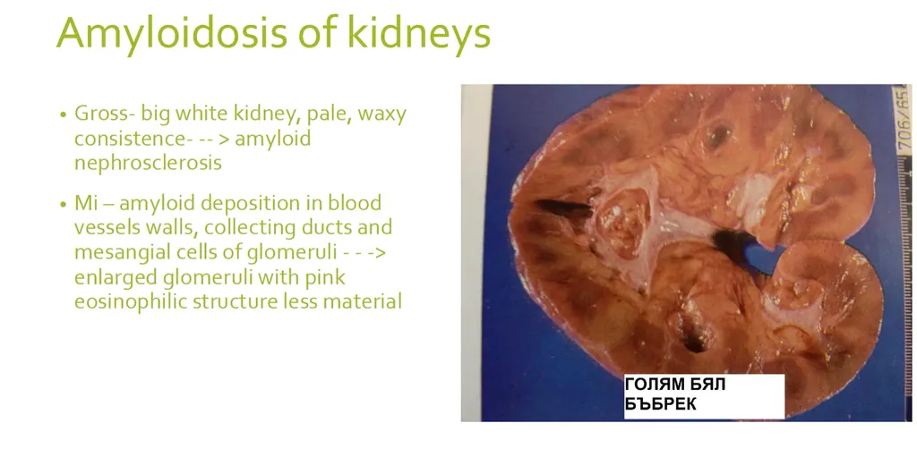 <p><strong><span>Which of the following microscopic descriptions most likely suggest kidney amyloidosis? The stain is H-E in all the described specimens. </span></strong></p><p><strong>a) highly enlarged glomeruli, the capillary tufts filled almost all of the capsular space, capillary lumens are obliterated; pink homogeneous substance is deposited also in the mesangium, in the basement membranes of the tubules and in the walls of the blood vessels, </strong></p><p>b) afferent and efferent arterioles have homogenously thick walls stained in pink, some of the glomeruli look smaller, with totally effaced structure and homogenously pink in color, while others may look normal in size, or even with compensatory hypertrophy, </p><p>c) the interstitium shows chronic inflammatory reaction, the main change is seen in the kidney tubules which look dilated and filled with pinkish substance (these tubules look like thyroid follicles), </p><p>d) many glomeruli show crescent proliferations, encompassing 2/3 of the Bowman’s space; the process ends with global sclerosis of the glomerulus</p>