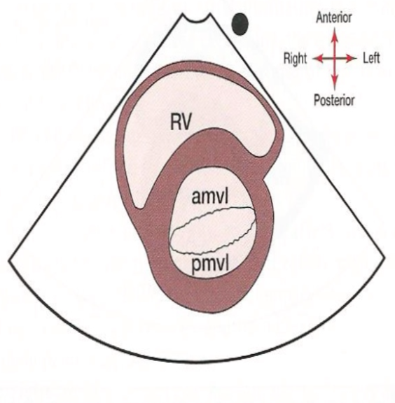 The fishes mouth created by the anterior and posterior mitral valve leaflets of the mitral valve.