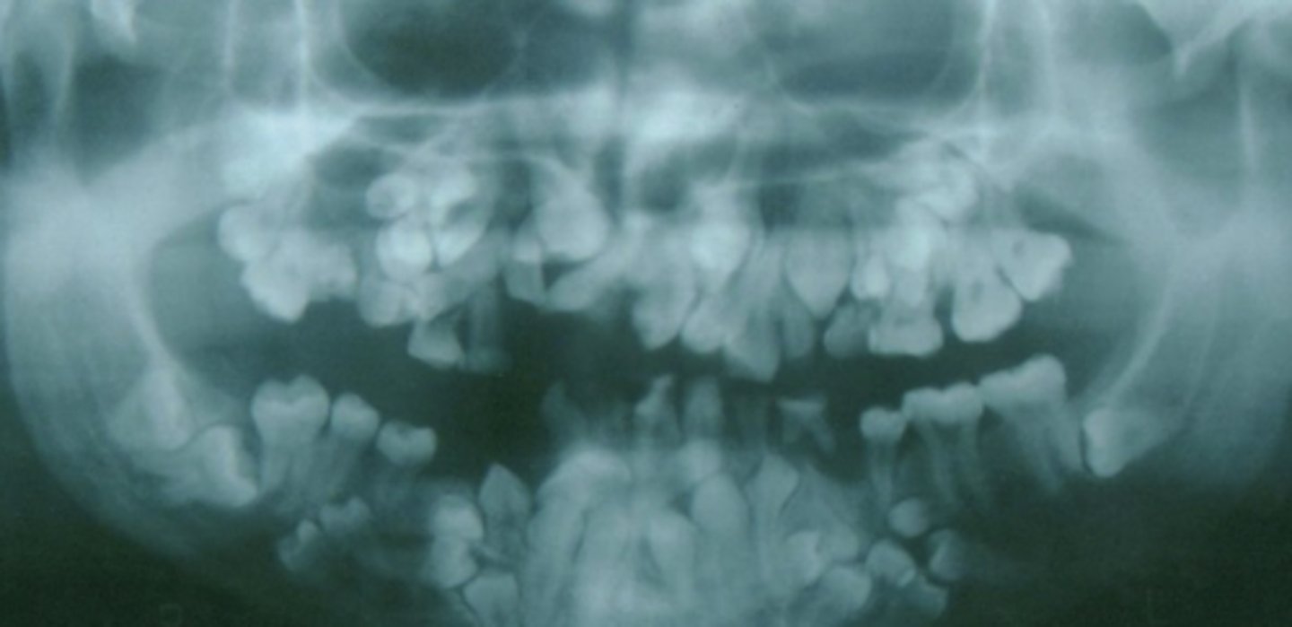 <p>- Lack of clavicles</p><p>- Many supernumerary, impacted teeth</p>